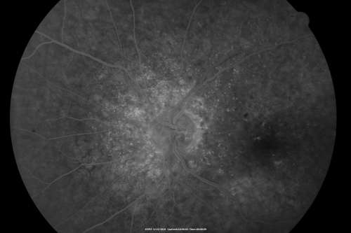Hypertensive Choroidopathy - Pheochromocytoma - Chronic Very High Blood Pressure 49 YO Male
49-year-old man chronic very high blood pressure sometimes the blood pressure will go as high as 260/160, sometimes it is 200/120 and sometimes it is 160/80.  He has a pheochromocytoma on the adrenal gland and he has had vision loss in the right eye starting between three and four years ago.  

VISUAL ACUITY:  OD 20/60,  OS 20/25.
