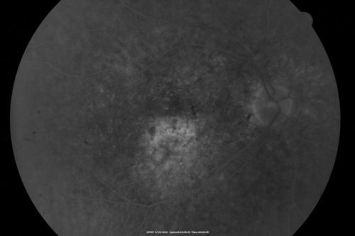 Hypertensive Choroidopathy - Pheochromocytoma - Chronic Very High Blood Pressure 49 YO Male
49-year-old man chronic very high blood pressure sometimes the blood pressure will go as high as 260/160, sometimes it is 200/120 and sometimes it is 160/80.  He has a pheochromocytoma on the adrenal gland and he has had vision loss in the right eye starting between three and four years ago.  

VISUAL ACUITY:  OD 20/60,  OS 20/25.
