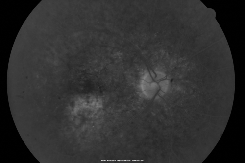 Hypertensive Choroidopathy - Pheochromocytoma - Chronic Very High Blood Pressure 49 YO Male
49-year-old man chronic very high blood pressure sometimes the blood pressure will go as high as 260/160, sometimes it is 200/120 and sometimes it is 160/80.  He has a pheochromocytoma on the adrenal gland and he has had vision loss in the right eye starting between three and four years ago.  

VISUAL ACUITY:  OD 20/60,  OS 20/25.
