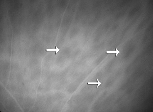 Birdshot Chorioretintis and PAMM
Patient presented with paracentral acute middle maculopathy as the presenting symptom of birdshot.  This case was published. RETINAL CASES & BRIEF REPORTS 10:151â€“153, 2016.
