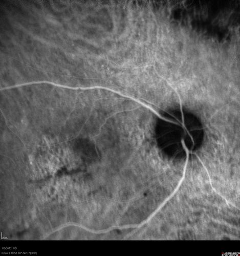 Post-Retinal Detachment Repair Occult Subfoveal CNVM
This pleasant 56-year-old man has had a complex retinal detachment repair in the right eye.  I most recently removed his silicone oil 3 months ago.  His vision now is the best it has ever been. 
VISUAL ACUITY:  OD 4/200
