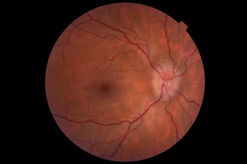 Papilledema - Benign Intracranial hypertension - Idiopathic intracranial hypertension
35 year old obese female.  Normal vision and headache.  Opening pressure was 30 cm water (normal 10-20).  Nerve swelling responded to diamox.
