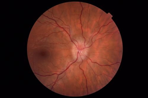 Papilledema - Benign Intracranial hypertension - Idiopathic intracranial hypertension
35 year old obese female.  Normal vision and headache.  Opening pressure was 30 cm water (normal 10-20).  Nerve swelling responded to diamox.

