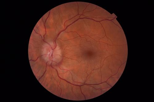 Papilledema - Benign Intracranial hypertension - Idiopathic intracranial hypertension
35 year old obese female.  Normal vision and headache.  Opening pressure was 30 cm water (normal 10-20).  Nerve swelling responded to diamox.
