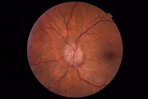 Papilledema - Benign Intracranial hypertension - Idiopathic intracranial hypertension
35 year old obese female.  Normal vision and headache.  Opening pressure was 30 cm water (normal 10-20).  Nerve swelling responded to diamox.
