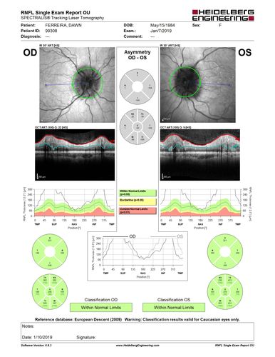 Papilledema - Benign Intracranial hypertension - Idiopathic intracranial hypertension
35 year old obese female.  Normal vision and headache.  Opening pressure was 30 cm water (normal 10-20).  Nerve swelling responded to diamox.
