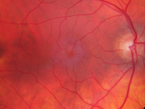 Juxtafoveal Telangiectasis - Stage 5 Left Eye - New Blood and Neovascularization MacTel 
60-year-old man has juxtafoveal retinal telangiectasis recent vision loss OD 20/50,  OS 20/70 : Hemorrhage OS and new SRNVM
