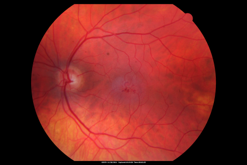 Juxtafoveal Telangiectasis - Stage 5 Left Eye - New Blood and Neovascularization MacTel 
60-year-old man has juxtafoveal retinal telangiectasis recent vision loss OD 20/50,  OS 20/70 : Hemorrhage OS and new SRNVM
