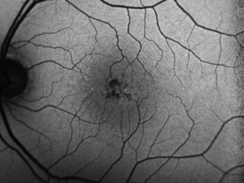 Juxtafoveal Telangiectasis - Stage 5 Left Eye - New Blood and Neovascularization MacTel FAF
60-year-old man has juxtafoveal retinal telangiectasis recent vision loss OD 20/50,  OS 20/70 : Hemorrhage OS and new SRNVM
