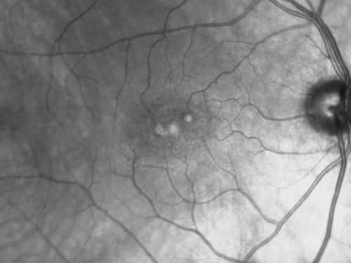 Juxtafoveal Telangiectasis - Stage 5 Left Eye - New Blood and Neovascularization MacTel 
60-year-old man has juxtafoveal retinal telangiectasis recent vision loss OD 20/50,  OS 20/70 : Hemorrhage OS and new SRNVM
