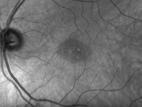 Juxtafoveal Telangiectasis - Stage 5 Left Eye - New Blood and Neovascularization MacTel 
60-year-old man has juxtafoveal retinal telangiectasis recent vision loss OD 20/50,  OS 20/70 : Hemorrhage OS and new SRNVM
