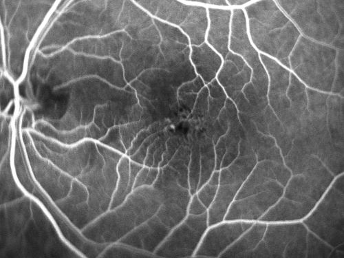 Juxtafoveal Telangiectasis - Stage 5 Left Eye - New Blood and Neovascularization MacTel 
60-year-old man has juxtafoveal retinal telangiectasis recent vision loss OD 20/50,  OS 20/70 : Hemorrhage OS and new SRNVM
