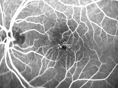 Juxtafoveal Telangiectasis - Stage 5 Left Eye - New Blood and Neovascularization MacTel 
60-year-old man has juxtafoveal retinal telangiectasis recent vision loss OD 20/50,  OS 20/70 : Hemorrhage OS and new SRNVM
