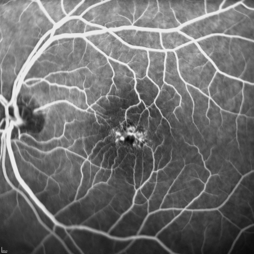 Juxtafoveal Telangiectasis - Stage 5 Left Eye - New Blood and Neovascularization MacTel 
60-year-old man has juxtafoveal retinal telangiectasis recent vision loss OD 20/50,  OS 20/70 : Hemorrhage OS and new SRNVM

