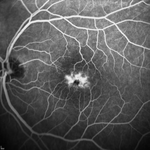 Juxtafoveal Telangiectasis - Stage 5 Left Eye - New Blood and Neovascularization MacTel 
60-year-old man has juxtafoveal retinal telangiectasis recent vision loss OD 20/50,  OS 20/70 : Hemorrhage OS and new SRNVM
