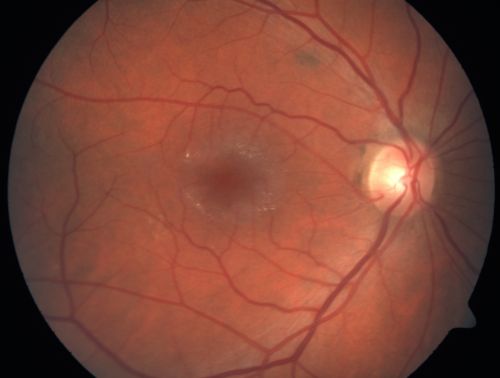 Juxtafoveal Telangiectasis - MacTel - Retinal Telangiectasis - Both Eyes - Crystals
61-year-old man has idiopathic juxtafoveal retinal telangiectasis type II in both eyes  OD is 20/40, OS is 20/25
