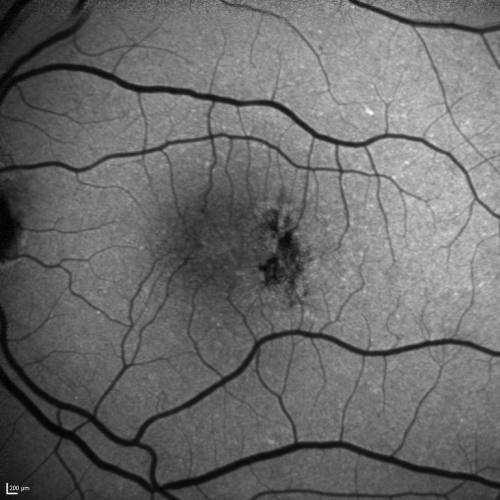 Group 2a Juxtafoveal Telangiectasis - MacTel - Stage 5 left eye - Macular Hole Right eye
76-year-old woman has juxtafoveal retinal telangiectasis.  She had Stage five neovascularization in the left eye I treated with injections between September of 2007 and October of 2008 with Avastin (3 years ago).  OCT scan today shows macular hole right eye. VISUAL ACUITY:  OD 20/400,  OS 20/40. 
