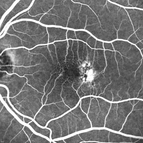 Group 2a Juxtafoveal Telangiectasis - MacTel - Stage 5 left eye - Macular Hole Right eye
76-year-old woman has juxtafoveal retinal telangiectasis.  She had Stage five neovascularization in the left eye I treated with injections between September of 2007 and October of 2008 with Avastin (3 years ago).  OCT scan today shows macular hole right eye. VISUAL ACUITY:  OD 20/400,  OS 20/40. 
