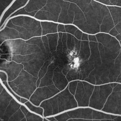Group 2a Juxtafoveal Telangiectasis - MacTel - Stage 5 left eye - Macular Hole Right eye
76-year-old woman has juxtafoveal retinal telangiectasis.  She had Stage five neovascularization in the left eye I treated with injections between September of 2007 and October of 2008 with Avastin (3 years ago).  OCT scan today shows macular hole right eye. VISUAL ACUITY:  OD 20/400,  OS 20/40. 
