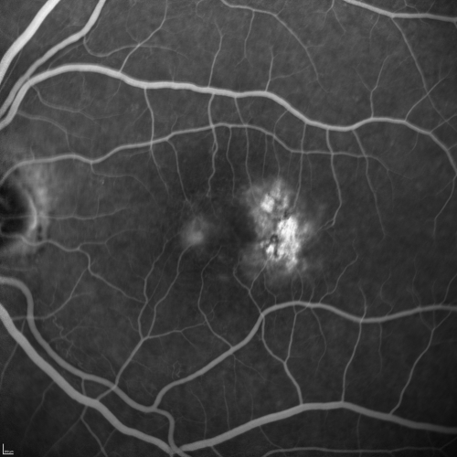 Group 2a Juxtafoveal Telangiectasis - MacTel - Stage 5 left eye - Macular Hole Right eye
76-year-old woman has juxtafoveal retinal telangiectasis.  She had Stage five neovascularization in the left eye I treated with injections between September of 2007 and October of 2008 with Avastin (3 years ago).  OCT scan today shows macular hole right eye. VISUAL ACUITY:  OD 20/400,  OS 20/40. 

