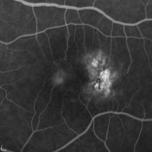 Group 2a Juxtafoveal Telangiectasis - MacTel - Stage 5 left eye - Macular Hole Right eye
76-year-old woman has juxtafoveal retinal telangiectasis.  She had Stage five neovascularization in the left eye I treated with injections between September of 2007 and October of 2008 with Avastin (3 years ago).  OCT scan today shows macular hole right eye. VISUAL ACUITY:  OD 20/400,  OS 20/40. 
