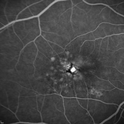 Group 2a Juxtafoveal Telangiectasis - MacTel - Stage 5 left eye - Macular Hole Right eye
76-year-old woman has juxtafoveal retinal telangiectasis.  She had Stage five neovascularization in the left eye I treated with injections between September of 2007 and October of 2008 with Avastin (3 years ago).  OCT scan today shows macular hole right eye. VISUAL ACUITY:  OD 20/400,  OS 20/40. 
