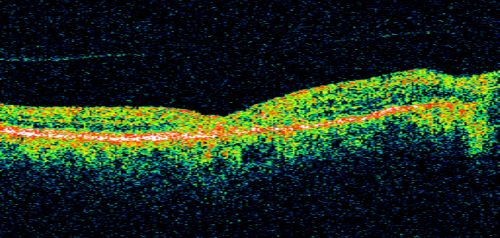 Juxtfoveal Telangiectasis Group 2a - Type II - MacTel - also Juxtapapillary Asymptomatic CNVM Right Eye
82-year-old woman who has juxtafoveal retinal telangiectasis in both eyes.  She recently had cataract surgery in the right eye and the vision in the right eye is still limited.   OD 20/100, OS 20/40.
