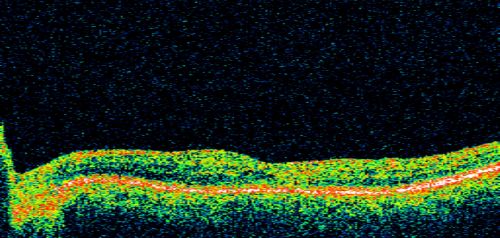 Juxtfoveal Telangiectasis Group 2a - Type II - MacTel - also Juxtapapillary Asymptomatic CNVM Right Eye
82-year-old woman who has juxtafoveal retinal telangiectasis in both eyes.  She recently had cataract surgery in the right eye and the vision in the right eye is still limited.   OD 20/100, OS 20/40.
