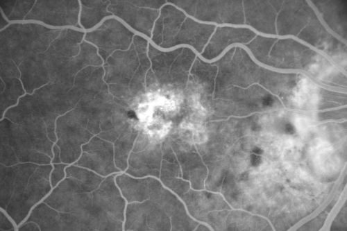 Juxtfoveal Telangiectasis Group 2a - Type II - MacTel - also Juxtapapillary Asymptomatic CNVM Right Eye
82-year-old woman who has juxtafoveal retinal telangiectasis in both eyes.  She recently had cataract surgery in the right eye and the vision in the right eye is still limited.   OD 20/100, OS 20/40.
