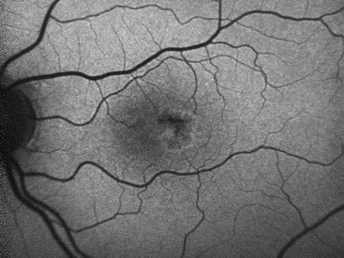 Juxtafoveal Telangiectasis (MacTel) and Asymptomatic Extrafoveal Juxtapapillary Choroidal Neovascular Membrane Fundus Autofluorescence
84-year-old woman has juxtafoveal retinal telangiectasis in both eyes.  The right eye has an asymptomatic extra foveal juxtapapillary choroidal neovascular membrane.    OD 20/400,  OS 20/63.
