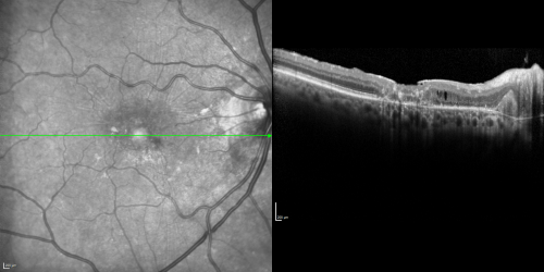 Juxtafoveal Telangiectasis (MacTel) and Asymptomatic Extrafoveal Juxtapapillary Choroidal Neovascular Membrane
84-year-old woman has juxtafoveal retinal telangiectasis in both eyes.  The right eye has an asymptomatic extra foveal juxtapapillary choroidal neovascular membrane.    OD 20/400,  OS 20/63.
