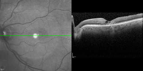 Juxtafoveal Telangiectasis (MacTel) and Asymptomatic Extrafoveal Juxtapapillary Choroidal Neovascular Membrane
84-year-old woman has juxtafoveal retinal telangiectasis in both eyes.  The right eye has an asymptomatic extra foveal juxtapapillary choroidal neovascular membrane.    OD 20/400,  OS 20/63.
