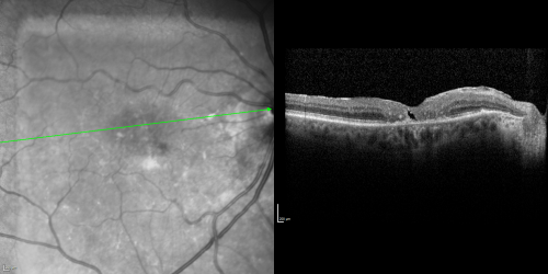 Juxtafoveal Telangiectasis (MacTel) and Asymptomatic Extrafoveal Juxtapapillary Choroidal Neovascular Membrane
84-year-old woman has juxtafoveal retinal telangiectasis in both eyes.  The right eye has an asymptomatic extra foveal juxtapapillary choroidal neovascular membrane.    OD 20/400,  OS 20/63.
