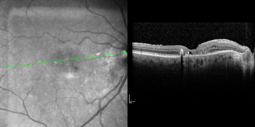 Juxtafoveal Telangiectasis (MacTel) and Asymptomatic Extrafoveal Juxtapapillary Choroidal Neovascular Membrane
84-year-old woman has juxtafoveal retinal telangiectasis in both eyes.  The right eye has an asymptomatic extra foveal juxtapapillary choroidal neovascular membrane.    OD 20/400,  OS 20/63.
