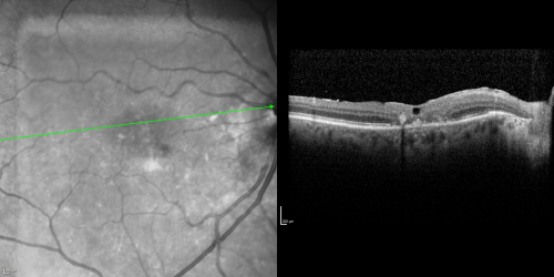 Juxtafoveal Telangiectasis (MacTel) and Asymptomatic Extrafoveal Juxtapapillary Choroidal Neovascular Membrane
84-year-old woman has juxtafoveal retinal telangiectasis in both eyes.  The right eye has an asymptomatic extra foveal juxtapapillary choroidal neovascular membrane.    OD 20/400,  OS 20/63.
