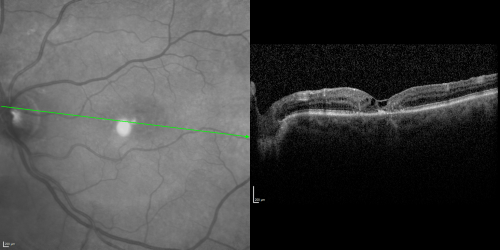 Juxtafoveal Telangiectasis (MacTel) and Asymptomatic Extrafoveal Juxtapapillary Choroidal Neovascular Membrane
84-year-old woman has juxtafoveal retinal telangiectasis in both eyes.  The right eye has an asymptomatic extra foveal juxtapapillary choroidal neovascular membrane.    OD 20/400,  OS 20/63.

