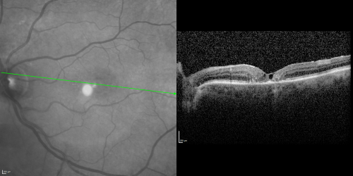 Juxtafoveal Telangiectasis (MacTel) and Asymptomatic Extrafoveal Juxtapapillary Choroidal Neovascular Membrane
84-year-old woman has juxtafoveal retinal telangiectasis in both eyes.  The right eye has an asymptomatic extra foveal juxtapapillary choroidal neovascular membrane.    OD 20/400,  OS 20/63.
