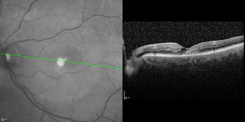 Juxtafoveal Telangiectasis (MacTel) and Asymptomatic Extrafoveal Juxtapapillary Choroidal Neovascular Membrane
84-year-old woman has juxtafoveal retinal telangiectasis in both eyes.  The right eye has an asymptomatic extra foveal juxtapapillary choroidal neovascular membrane.    OD 20/400,  OS 20/63.
