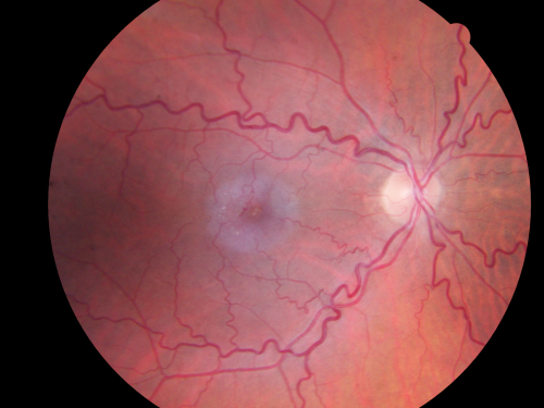 Juxtafoveal Retinal Telangiectasia (Telangiectasis) - MacTel - Striking Gray Ring in Macula
59-year-old woman decreasing vision in the right eye for a few years.  She has had diabetes for five years.  OD 20/100,  Pinhole 20/40.  OS 20/20
