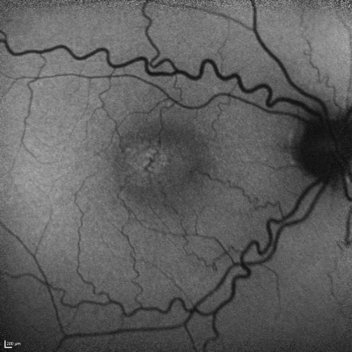Juxtafoveal Retinal Telangiectasia (Telangiectasis) - MacTel - Striking Gray Ring in Macula - Funuds Autofluorescence
59-year-old woman decreasing vision in the right eye for a few years.  She has had diabetes for five years.  OD 20/100,  Pinhole 20/40.  OS 20/20
