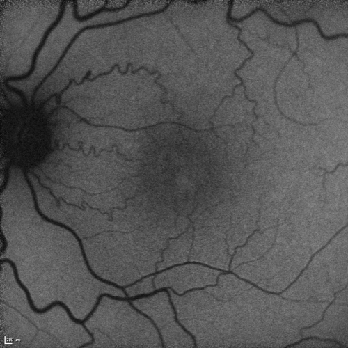 Juxtafoveal Retinal Telangiectasia (Telangiectasis) - MacTel - Striking Gray Ring in Macula - Funuds Autofluorescence
59-year-old woman decreasing vision in the right eye for a few years.  She has had diabetes for five years.  OD 20/100,  Pinhole 20/40.  OS 20/20
