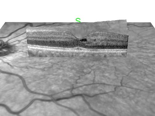 Juxtafoveal Retinal Telangiectasia (Telangiectasis) - MacTel - Striking Gray Ring in Macula
59-year-old woman decreasing vision in the right eye for a few years.  She has had diabetes for five years.  OD 20/100,  Pinhole 20/40.  OS 20/20
