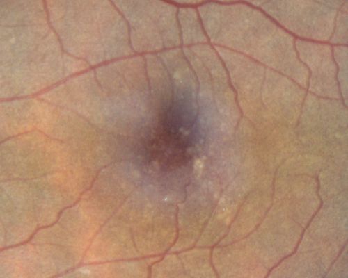 Juxtafoveal Telangiectasis - After Hemorrhage Absorbed Right Eye with Avastin Injections
73-year-old woman has juxtafoveal retinal telangiectasis in both eyes.  The right eye has stage 5 disease.  Her last Avastin treatment in the right eye was in 6 months ago.  The right eye has been the worst of her two eyes for years.

VISUAL ACUITY: Vision OD is 20/200, OS is 20/50.  

