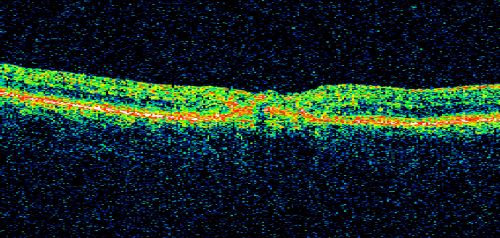 Juxtafoveal Telangiectasis - After Hemorrhage Absorbed Right Eye with Avastin Injections
73-year-old woman has juxtafoveal retinal telangiectasis in both eyes.  The right eye has stage 5 disease.  Her last Avastin treatment in the right eye was in 6 months ago.  The right eye has been the worst of her two eyes for years.

VISUAL ACUITY: Vision OD is 20/200, OS is 20/50.  

