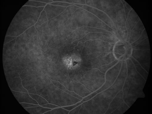 Juxtafoveal Telangiectasis - After Hemorrhage Absorbed Right Eye with Avastin Injections
73-year-old woman has juxtafoveal retinal telangiectasis in both eyes.  The right eye has stage 5 disease.  Her last Avastin treatment in the right eye was in 6 months ago.  The right eye has been the worst of her two eyes for years.

VISUAL ACUITY: Vision OD is 20/200, OS is 20/50.  

