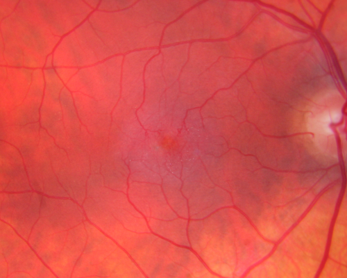 Group 2a Juxtafoveal Retinal Telangiectasis (type 2)
58-year-old man decreased vision right eye and not better since cataract surgery one year ago.  OD 20/40,  OS 20/40.
Schlüsselwörter: ijft;mactel;crystals