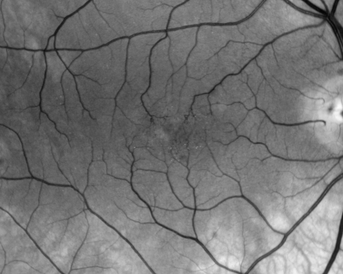 Group 2a Juxtafoveal Retinal Telangiectasis (type 2)
58-year-old man decreased vision right eye and not better since cataract surgery one year ago.  OD 20/40,  OS 20/40.
Keywords: ijft;mactel;crystals