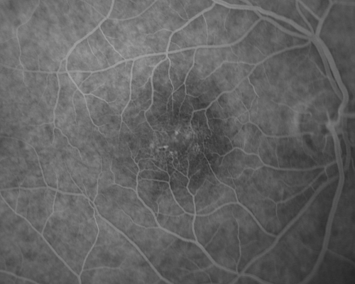 Group 2a Juxtafoveal Retinal Telangiectasis (type 2)
58-year-old man decreased vision right eye and not better since cataract surgery one year ago.  OD 20/40,  OS 20/40.
Keywords: ijft;mactel;crystals