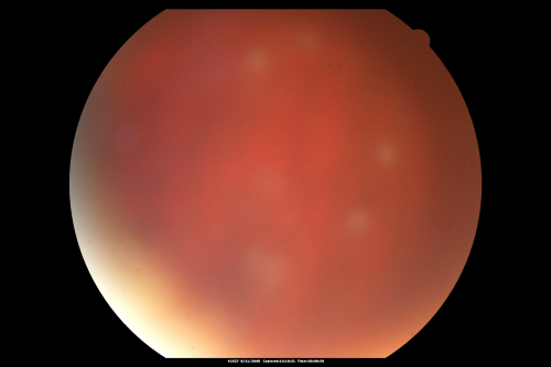 Fungal Endophthalmitis
65-year-old woman had chronic endophthalmitis in the left eye 1 day post-op vitrectomy.
Keywords: fungal endophthalmitis;retinitis;