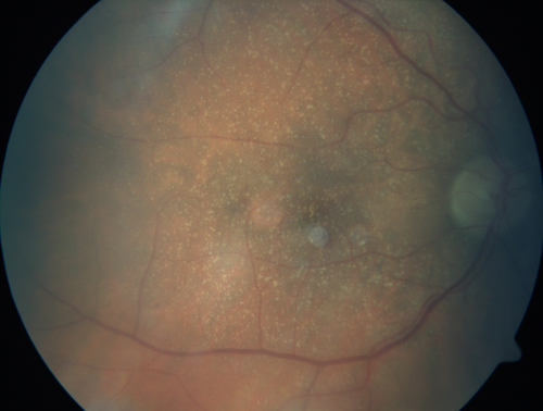 Unusual Intraretinal Deposits
71 year old diabetic man on dialysis with 20/20 vision and intraretinal deposits.  Recent 150 lb weight loss, on dialysis, see album properties for full history
